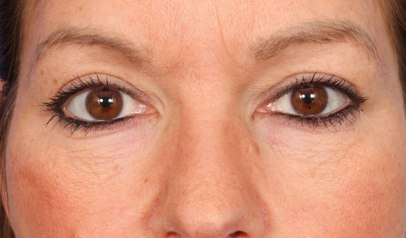 Blepharoplasty Before & After Image