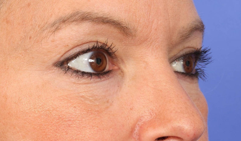 Blepharoplasty Before & After Image