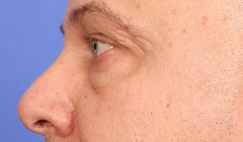 Blepharoplasty Before & After Image