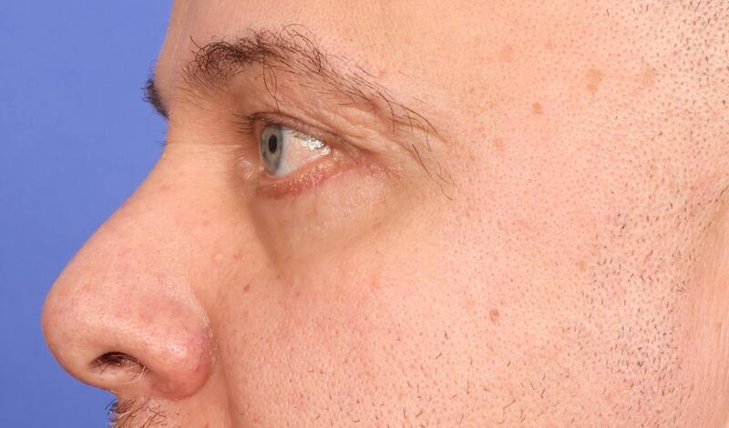 Blepharoplasty Before & After Image