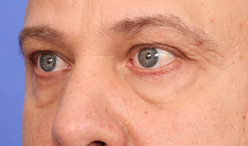 Blepharoplasty Before & After Image