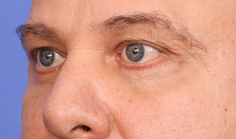 Blepharoplasty Before & After Image