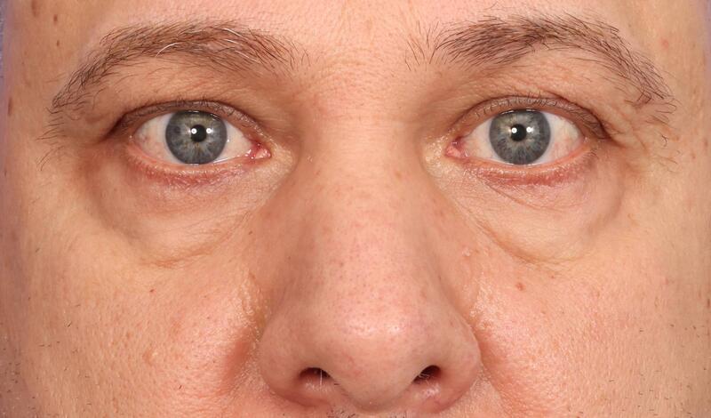 Blepharoplasty Before & After Image