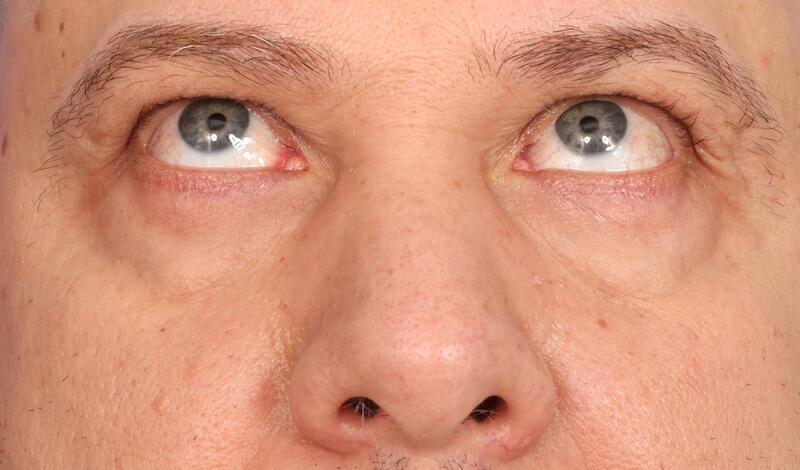 Blepharoplasty Before & After Image