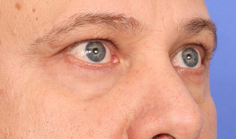 Blepharoplasty Before & After Image