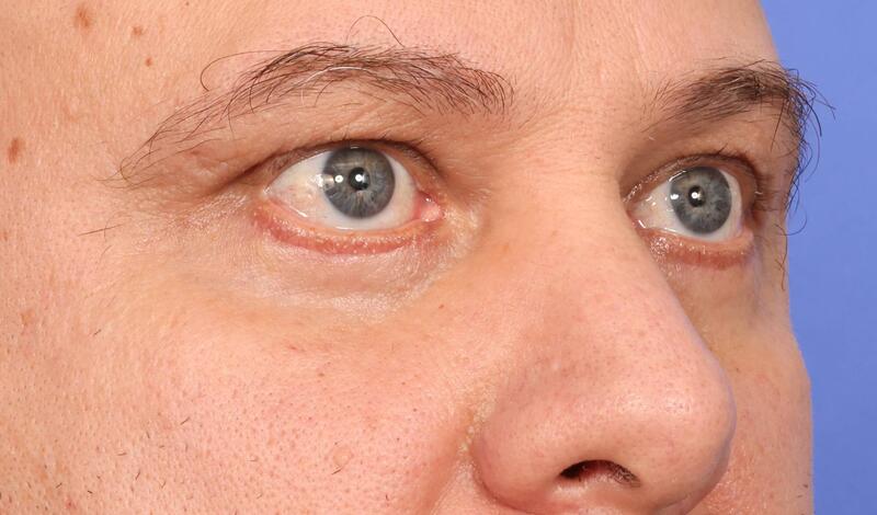 Blepharoplasty Before & After Image