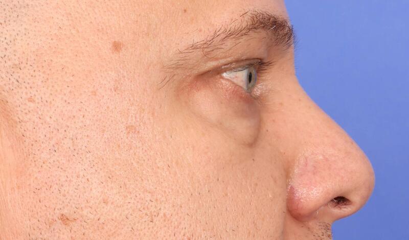 Blepharoplasty Before & After Image