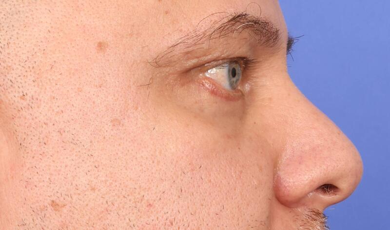 Blepharoplasty Before & After Image