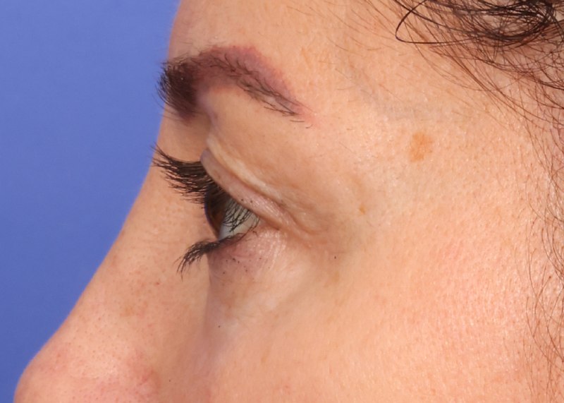 Blepharoplasty Before & After Image