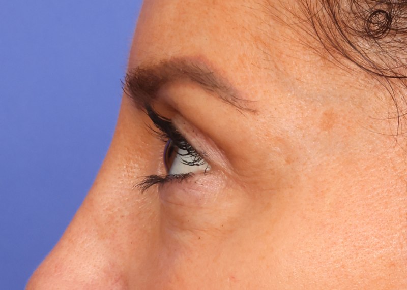 Blepharoplasty Before & After Image