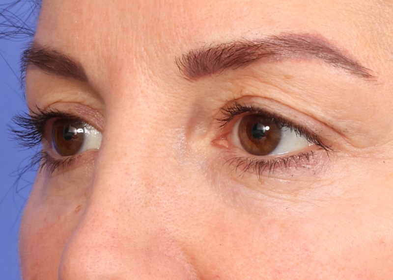 Blepharoplasty Before & After Image