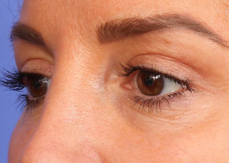 Blepharoplasty Before & After Image