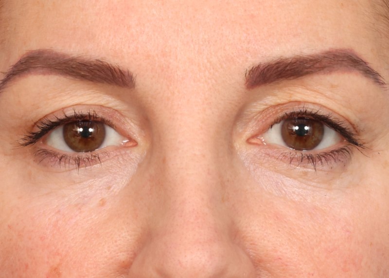 Blepharoplasty Before & After Image