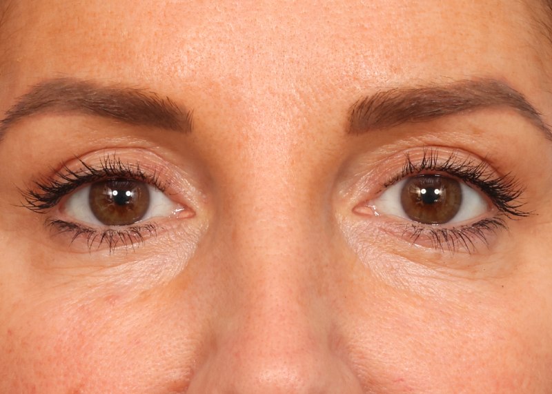 Blepharoplasty Before & After Image