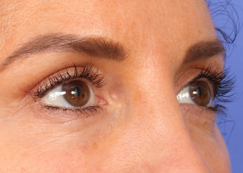 Blepharoplasty Before & After Image