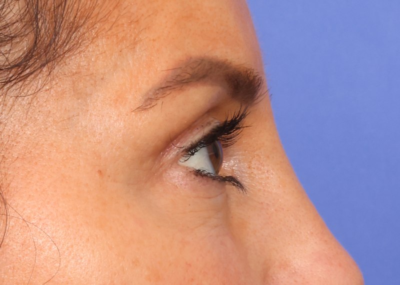 Blepharoplasty Before & After Image