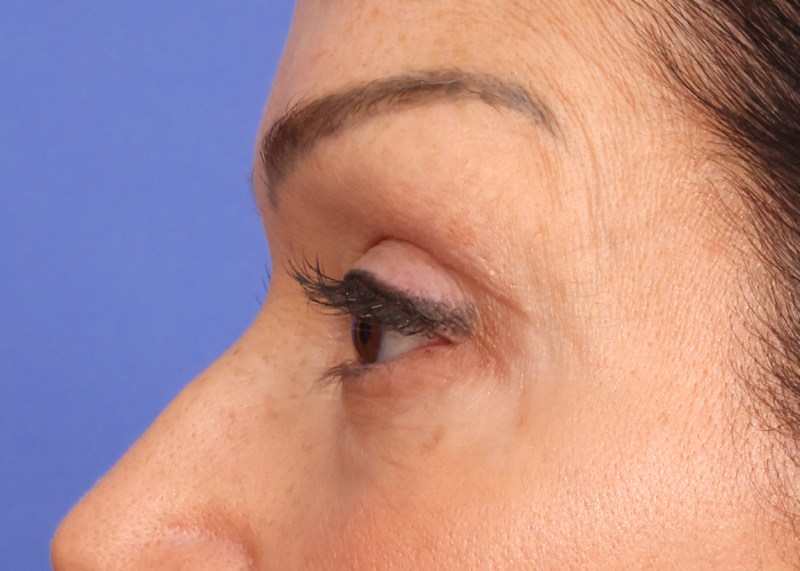 Blepharoplasty Before & After Image