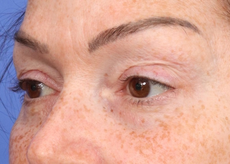 Blepharoplasty Before & After Image