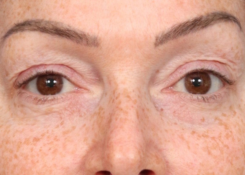 Blepharoplasty Before & After Image