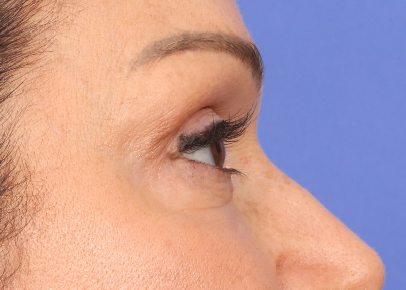 Blepharoplasty Before & After Image