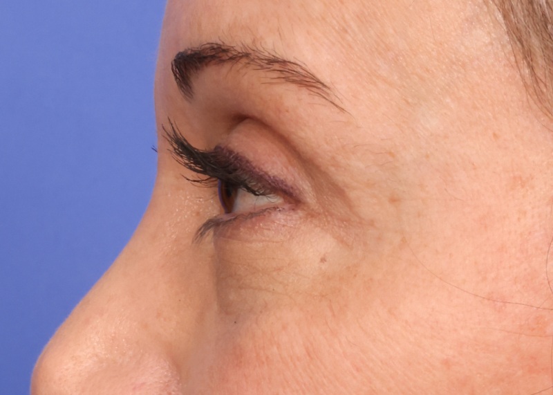 Blepharoplasty Before & After Image