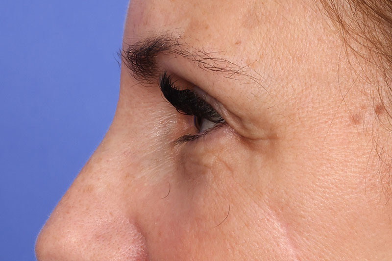 Blepharoplasty Before & After Image