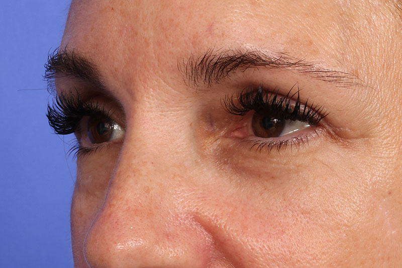 Blepharoplasty Before & After Image