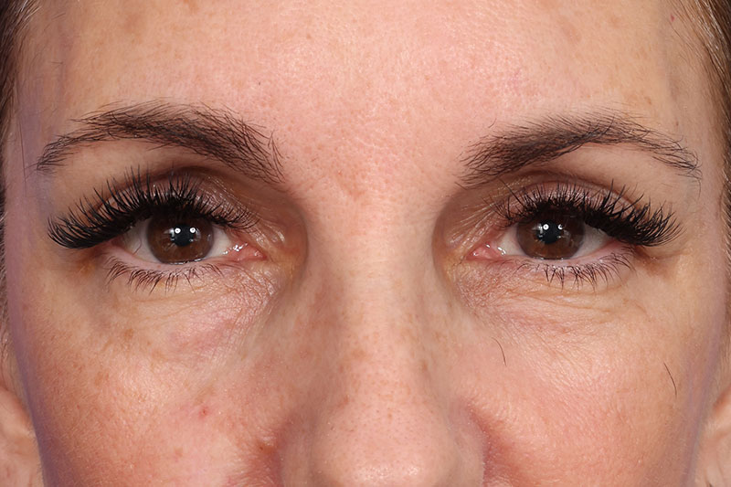 Blepharoplasty Before & After Image