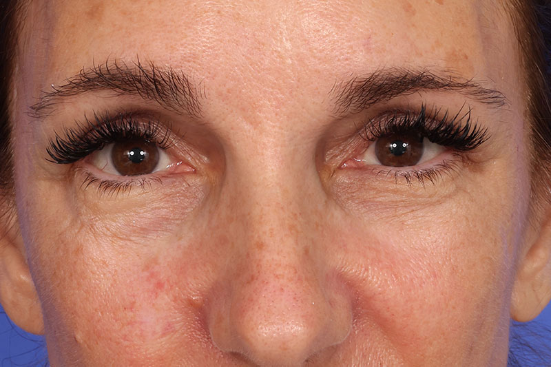 Blepharoplasty Before & After Image