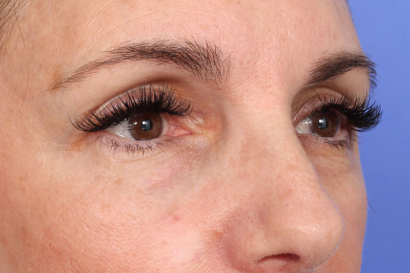 Blepharoplasty Before & After Image