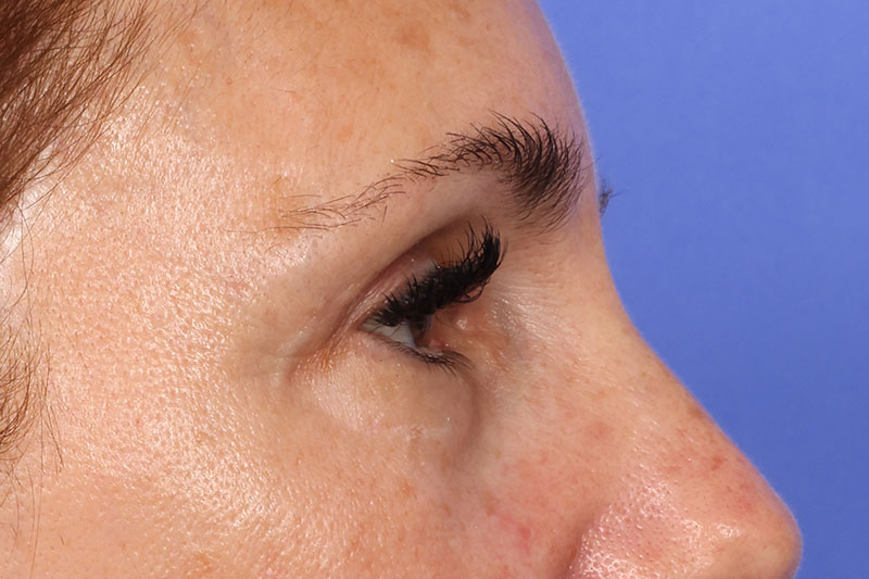 Blepharoplasty Before & After Image