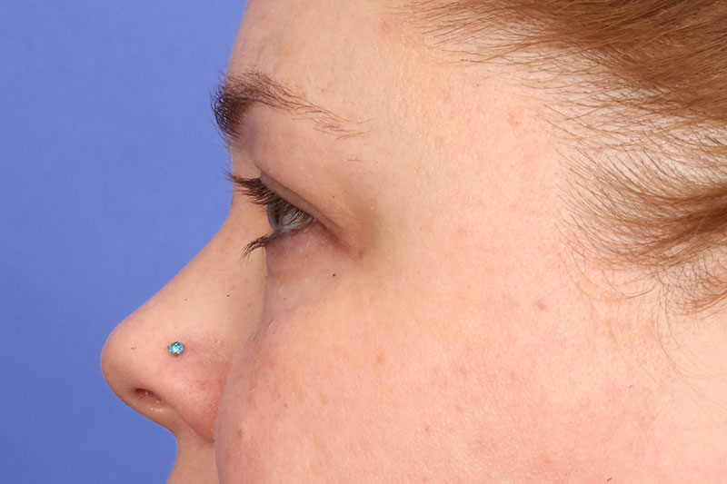 Blepharoplasty Before & After Image