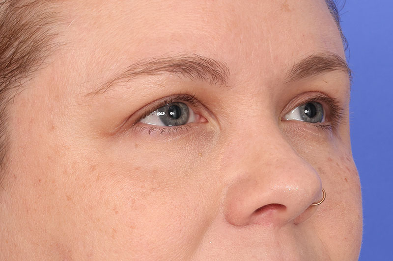 Blepharoplasty Before & After Image