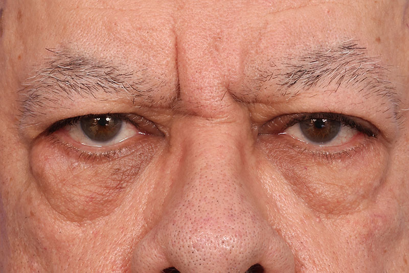 Blepharoplasty Before & After Image