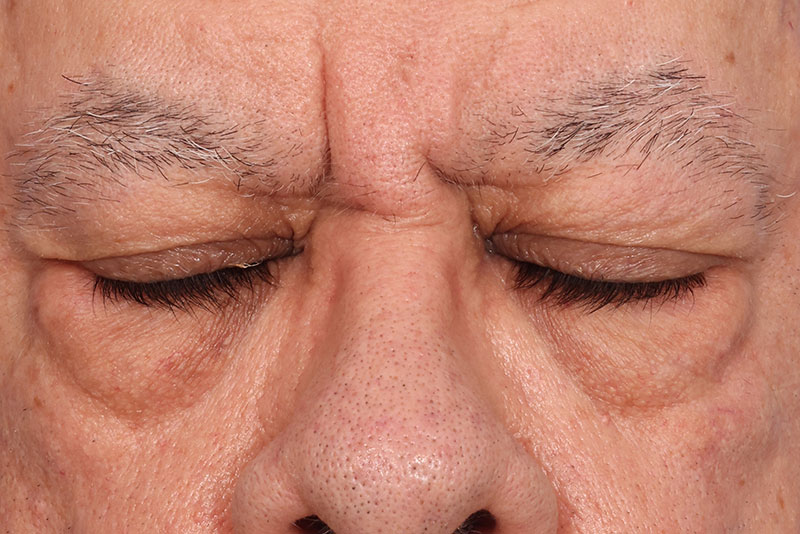 Blepharoplasty Before & After Image