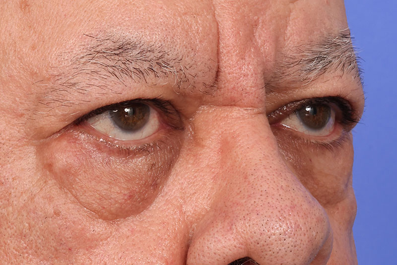 Blepharoplasty Before & After Image