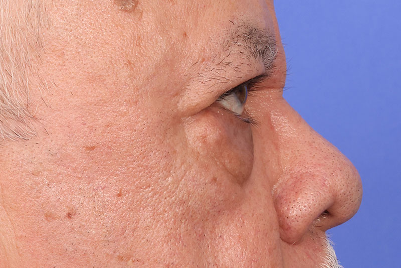 Blepharoplasty Before & After Image