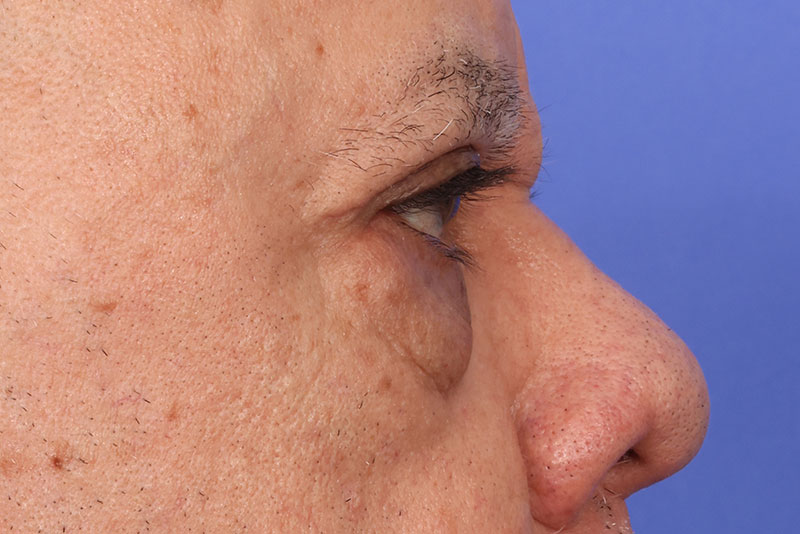 Blepharoplasty Before & After Image