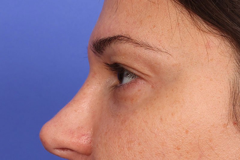 Blepharoplasty Before & After Image