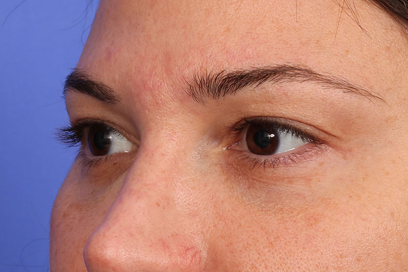 Blepharoplasty Before & After Image