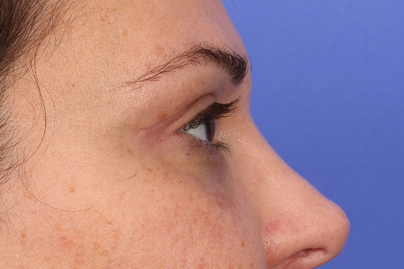 Blepharoplasty Before & After Image