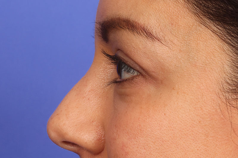 Blepharoplasty Before & After Image