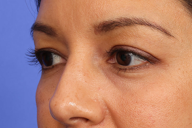 Blepharoplasty Before & After Image