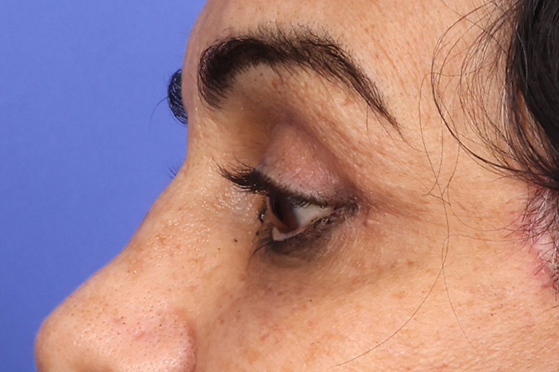 Blepharoplasty Before & After Image