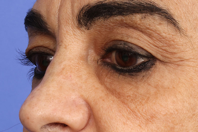 Blepharoplasty Before & After Image