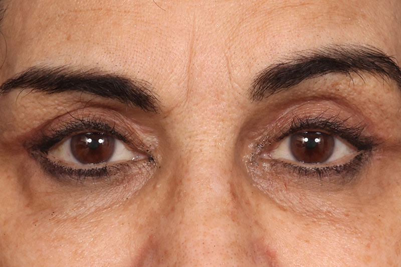 Blepharoplasty Before & After Image