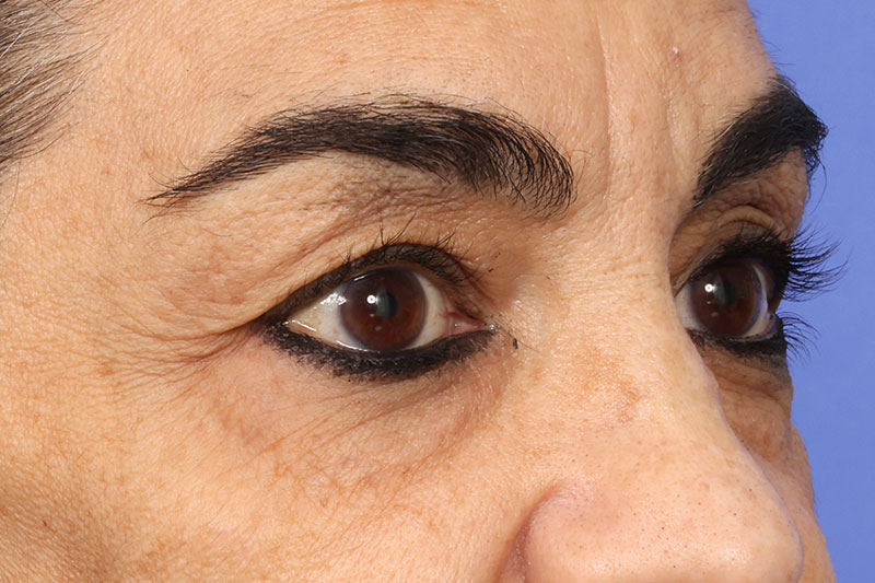 Blepharoplasty Before & After Image