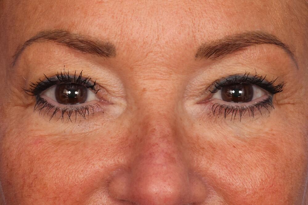 Blepharoplasty Before & After Image