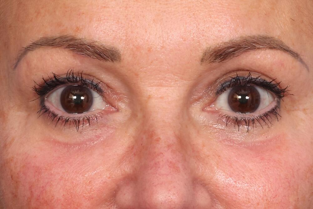 Blepharoplasty Before & After Image