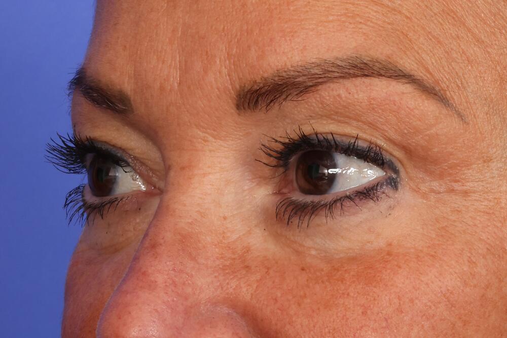 Blepharoplasty Before & After Image